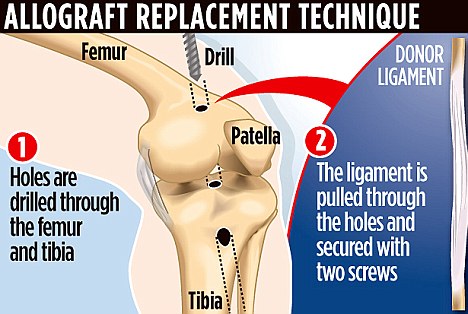 Allograft