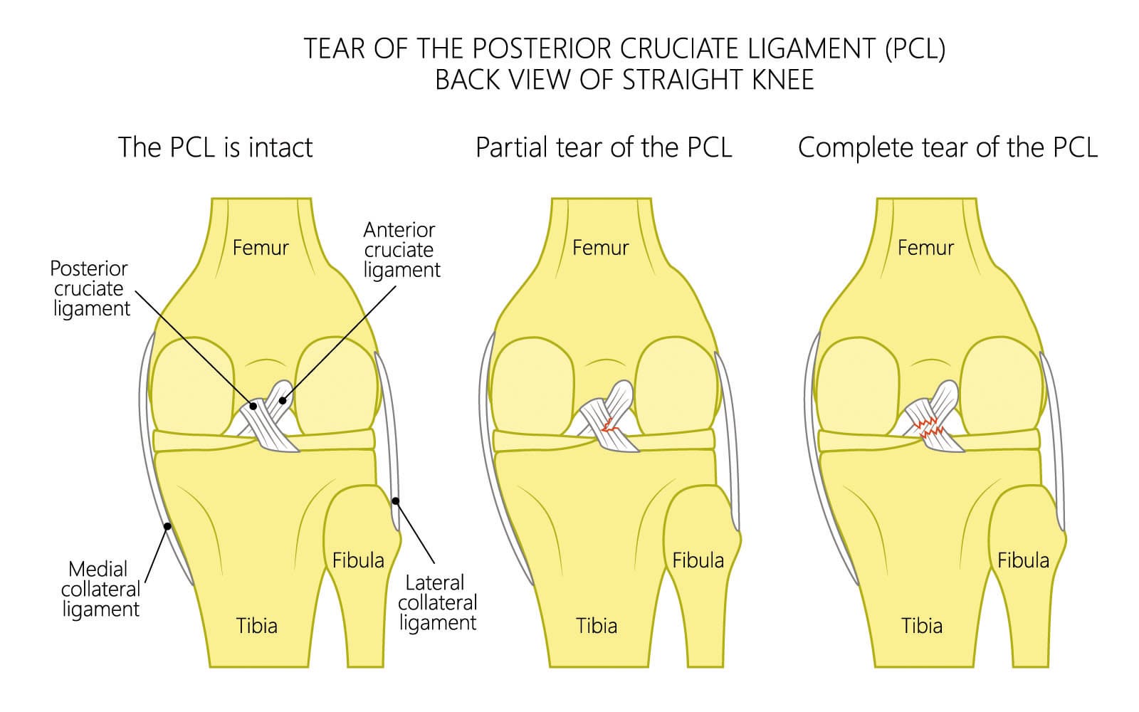 Torn ACL